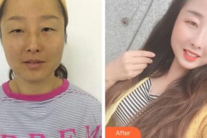 杭州富陽柏氏眼科醫(yī)院馬麗卿整形價(jià)格表附內(nèi)切祛眼袋案例展示