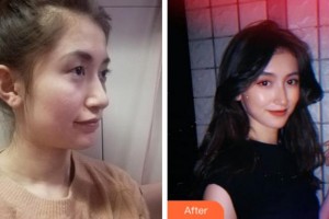 杭州富陽柏氏眼科醫(yī)院謝毅杰整形價(jià)格表附眼部綜合案例展示