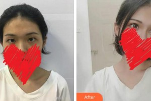 杭州富陽柏氏眼科醫(yī)院王劍勇整形價(jià)格表附切開雙眼皮案例展示