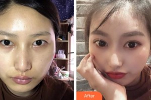 杭州求是眼科醫(yī)院姚玉峰整形價(jià)格表附切開雙眼皮案例展示