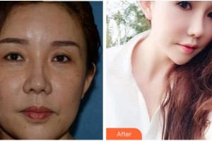 杭州求是眼科醫(yī)院張洪勛整形價(jià)格表附外切祛眼袋案例展示