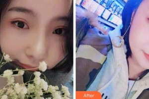 杭州品凱口腔醫(yī)院趙士芳整形價(jià)格表附牙齒隱形矯正案例展示