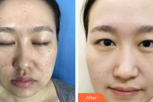 廣州市中西醫(yī)結(jié)合醫(yī)院燒傷整形外科林桂清整形價(jià)格表附微針美膚案例展示