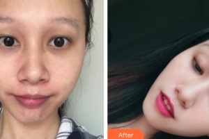 中信惠州醫(yī)院醫(yī)學(xué)整形中心楊光成整形價(jià)格表附微針美膚案例展示