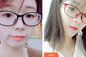 惠州元辰醫(yī)療美容門診部葉明龍整形價(jià)格表附水氧活膚案例展示