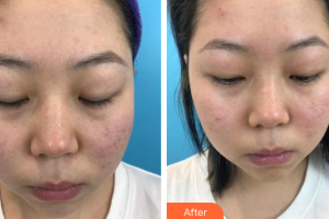 惠州市中心人民醫(yī)院整形燒傷科黃穎江整形價(jià)格表附紅藍(lán)光祛痘案例展示