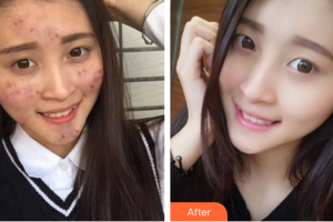 惠州市中心人民醫(yī)院整形燒傷科陳奇鳴整形價(jià)格表附紅藍(lán)光祛痘案例展示