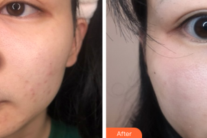 惠州市中心人民醫(yī)院整形燒傷科徐俊賜整形價(jià)格表附果酸煥膚案例展示