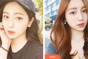 惠州市中心人民醫(yī)院整形燒傷科孟宏整形價格表附光子嫩膚案例展示