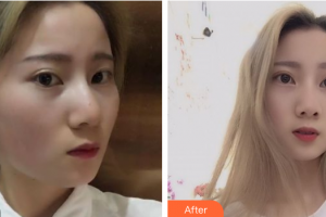 惠州市中心人民醫(yī)院整形燒傷科余林權整形價格表附果酸換膚案例展示