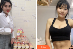 惠州鵬愛(ài)醫(yī)療美容醫(yī)院黃華軍整形價(jià)格表附全身吸脂案例展示