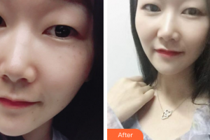 惠州伊麗莎白整形美容醫(yī)院鄧蕓整形價(jià)格表附激光祛斑案例展示