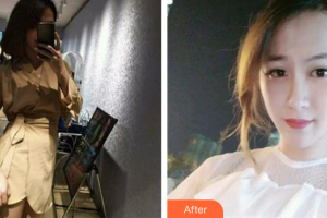 中信惠州醫(yī)院醫(yī)學整形中心吳正峯整形價格表附點陣激光祛妊娠紋案例展示