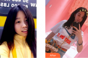 中信惠州醫(yī)院醫(yī)學整形中心王少榮整形價格表附超聲波潔牙案例展示