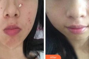 中信惠州醫(yī)院醫(yī)學整形中心鄒潔整形價格表附祛斑祛痣案例展示