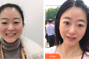 中信惠州醫(yī)院醫(yī)學整形中心單成方整形價格表附隱形牙齒案例展示