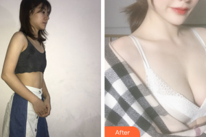 惠州元辰醫(yī)療美容門診部袁新平整形價格表附假體隆胸案例展示