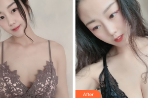 惠州微美醫(yī)療美容診所高清華整形價格表附自體脂肪隆胸案例展示