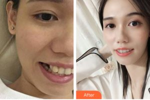 惠州白天鵝口腔醫(yī)院張梅梅整形價格表附牙齒矯正案例展示