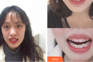 惠州白天鵝口腔醫(yī)院明鑫榮整形價格表附隱形牙齒矯正案例展示