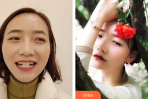 惠州白天鵝口腔醫(yī)院鞠遠福整形價格表附隱形矯正案例展示