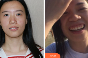 惠州白天鵝口腔醫(yī)院付美清整形價格表附隱形托槽矯正案例展示