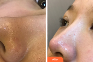 惠州元辰醫(yī)療美容門診部張琳整形價格表附清潔祛痘案例展示