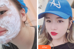 中信惠州醫(yī)院醫(yī)學整形中心余文建整形價格表附微針美膚案例展示