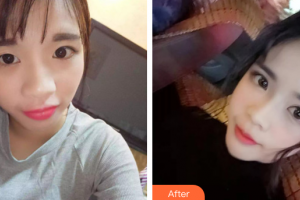 惠州雅涵醫(yī)療美容門診部曾詳宏整形價格表附無針水光案例展示