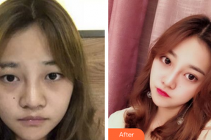 惠州市第一人民醫(yī)院眼科馮育基整形價格表附眼部手術案例展示