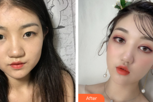 惠州市第一人民醫(yī)院眼科張世華整形價格表附眼部整形案例展示