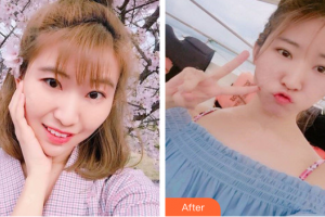 惠州市第一人民醫(yī)院眼科李娜整形價格表附切開雙眼皮案例展示