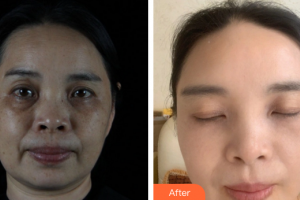 韶關(guān)艾瑞美容醫(yī)院唐慧整形價格表附激光祛斑案例展示