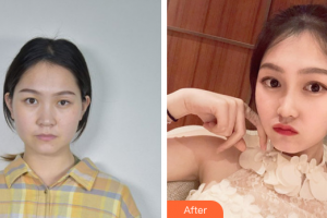 韶關(guān)愛爾眼科醫(yī)院馬麗娜整形價格表附眼部整形案例展示