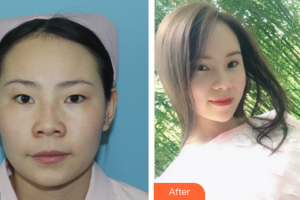 韶關(guān)愛爾眼科醫(yī)院丘韶瓊整形價格表附精細切開雙眼皮案例展示