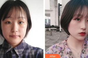 韶關(guān)愛爾眼科醫(yī)院蔡欣整形價格表附祛眼袋案例展示