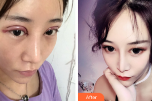 韶關(guān)愛爾眼科醫(yī)院詹衛(wèi)群整形價格表附切開雙眼皮案例展示