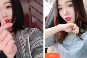 杭州品凱口腔醫(yī)院芳整形價(jià)格表附牙齒隱形矯正案例展示