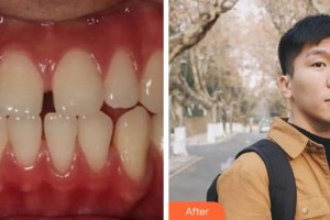 杭州品凱口腔醫(yī)院張城鎮(zhèn)整形價(jià)格表附金屬托槽矯正案例展示