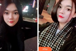 杭州品凱口腔醫(yī)院秦芳整形價(jià)格表附牙齒隱形矯正案例展示