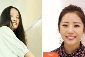 杭州市富陽區(qū)第一人民醫(yī)院燒傷整形外科唐曉明整形價(jià)格表附牙齒隱形矯正案例展示