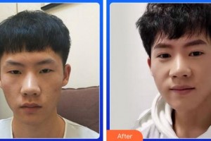 杭州市富陽區(qū)中醫(yī)院眼科張建亨整形價(jià)格表附切開雙眼皮案例展示