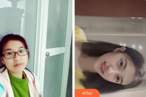 杭州亮貝美口腔醫(yī)院水文軍整形價(jià)格表附金屬托槽矯正案例展示