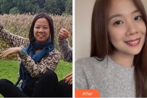 杭州維信口腔門診部古新月整形價(jià)格表附金屬托槽矯正案例展示