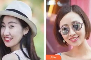 杭州良渚口腔門診部毛俏蕾整形價(jià)格表附隱形托槽矯正案例展示