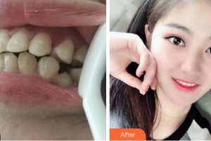 杭州博凡口腔門診部林毅整形價(jià)格表附金屬托槽矯正案例展示