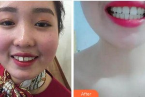 杭州國(guó)雅口腔醫(yī)院萬(wàn)成鋒整形價(jià)格表附牙齒隱形矯正案例展示