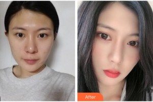 杭州太學(xué)眼科門診部余威德整形價(jià)格表附眼部綜合案例展示