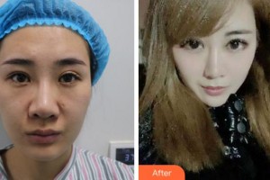 杭州愛爾眼科醫(yī)院肖前峰整形價(jià)格表附眼部綜合案例展示