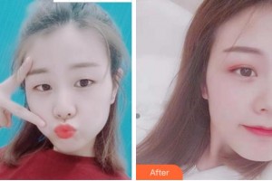 杭州西湖之江眼科醫(yī)院俞阿勇整形價(jià)格表附切開雙眼皮案例展示